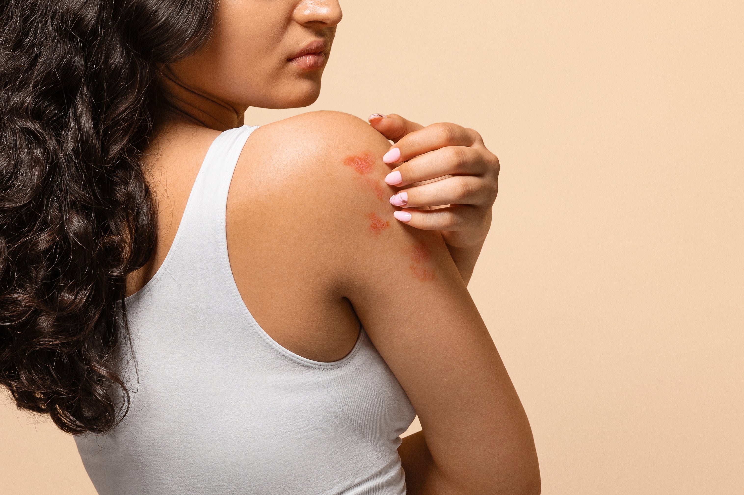 How LED red-light therapy can alleviate psoriasis and eczema