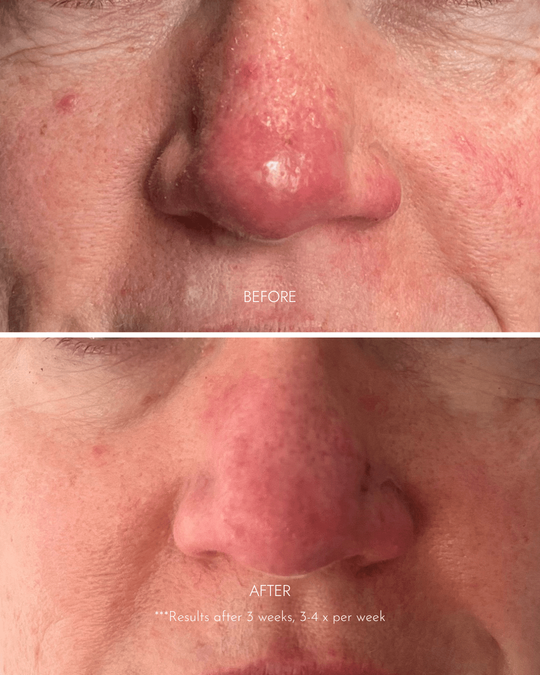 led light therapy before and after