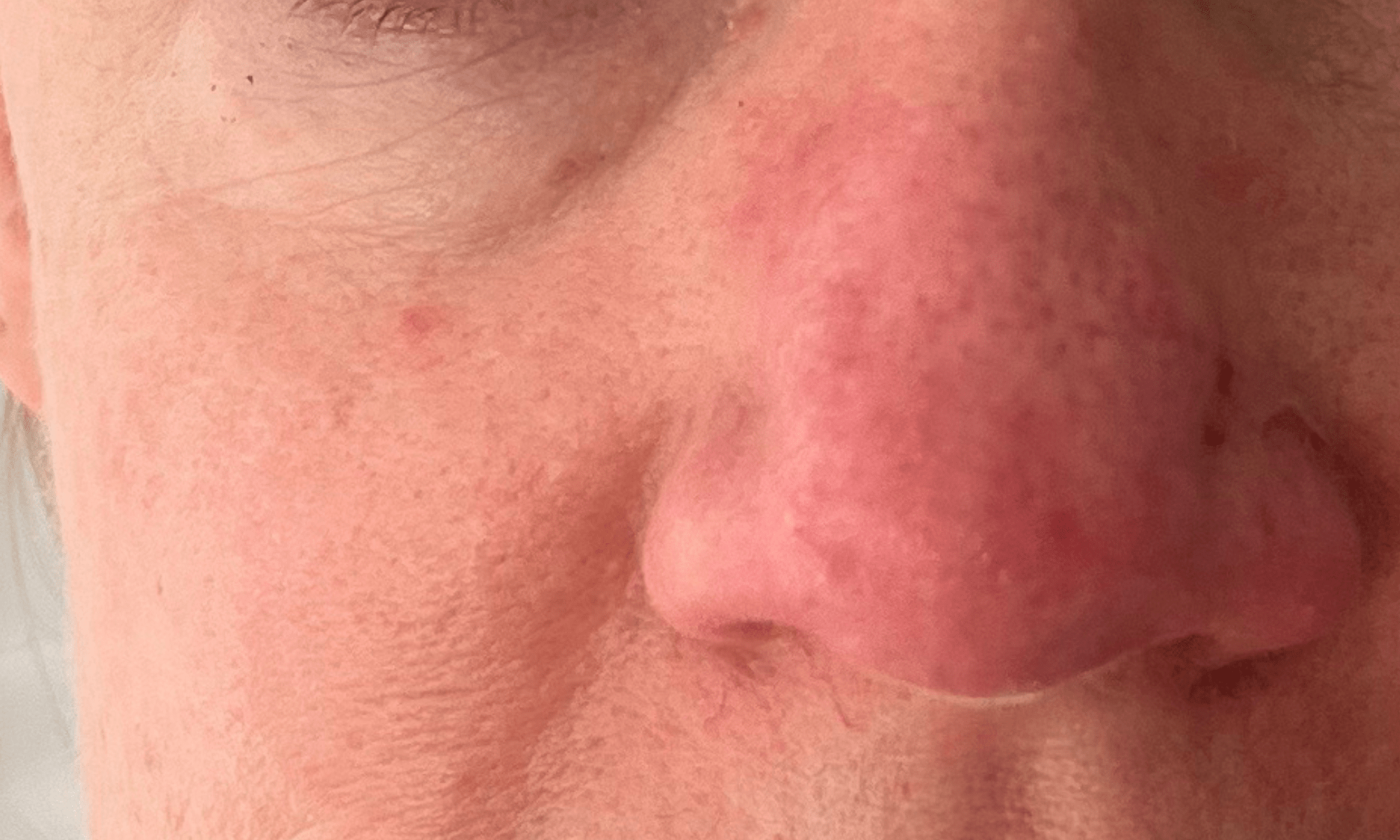 red light therapy before and after