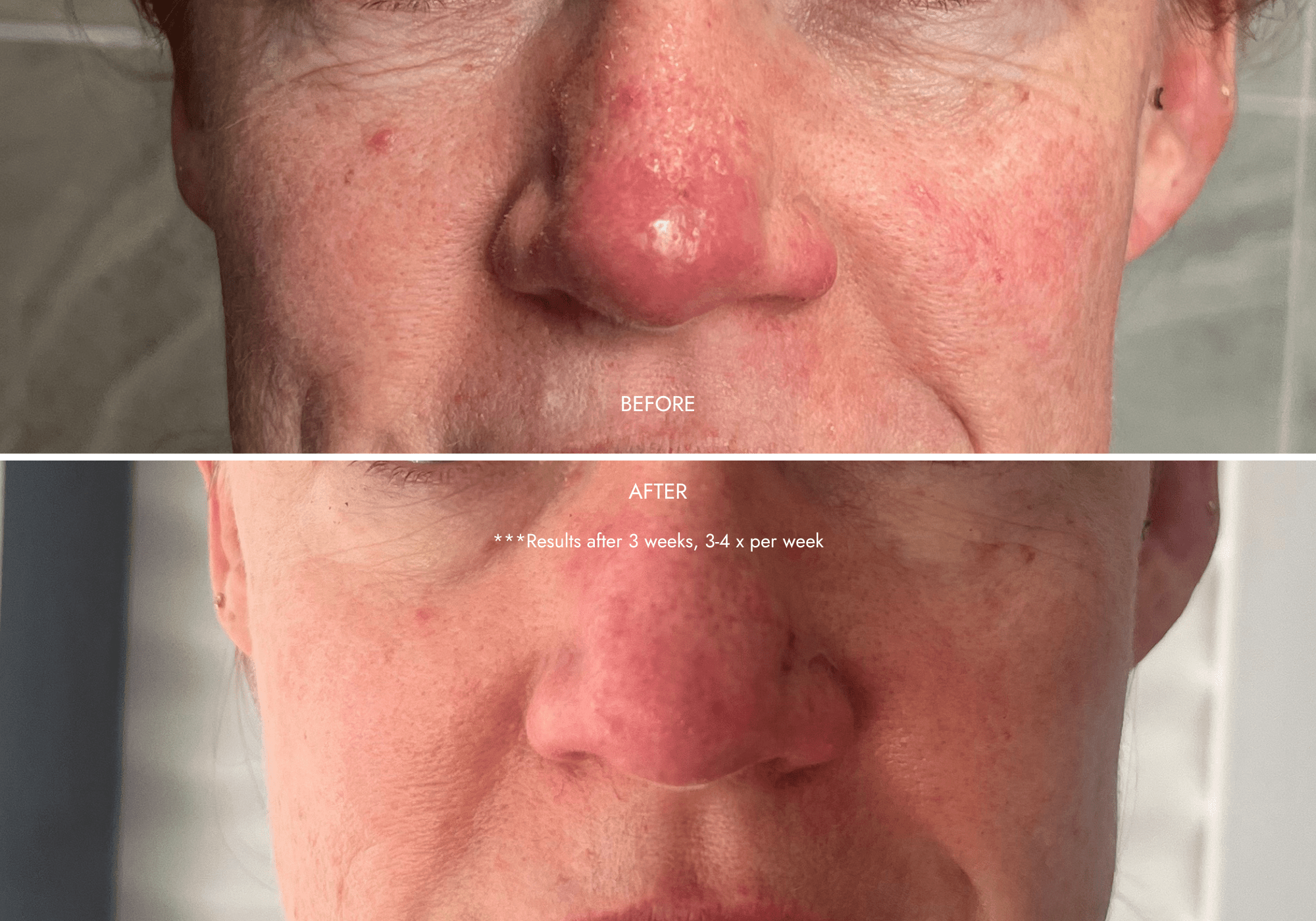 red light therapy before and after
