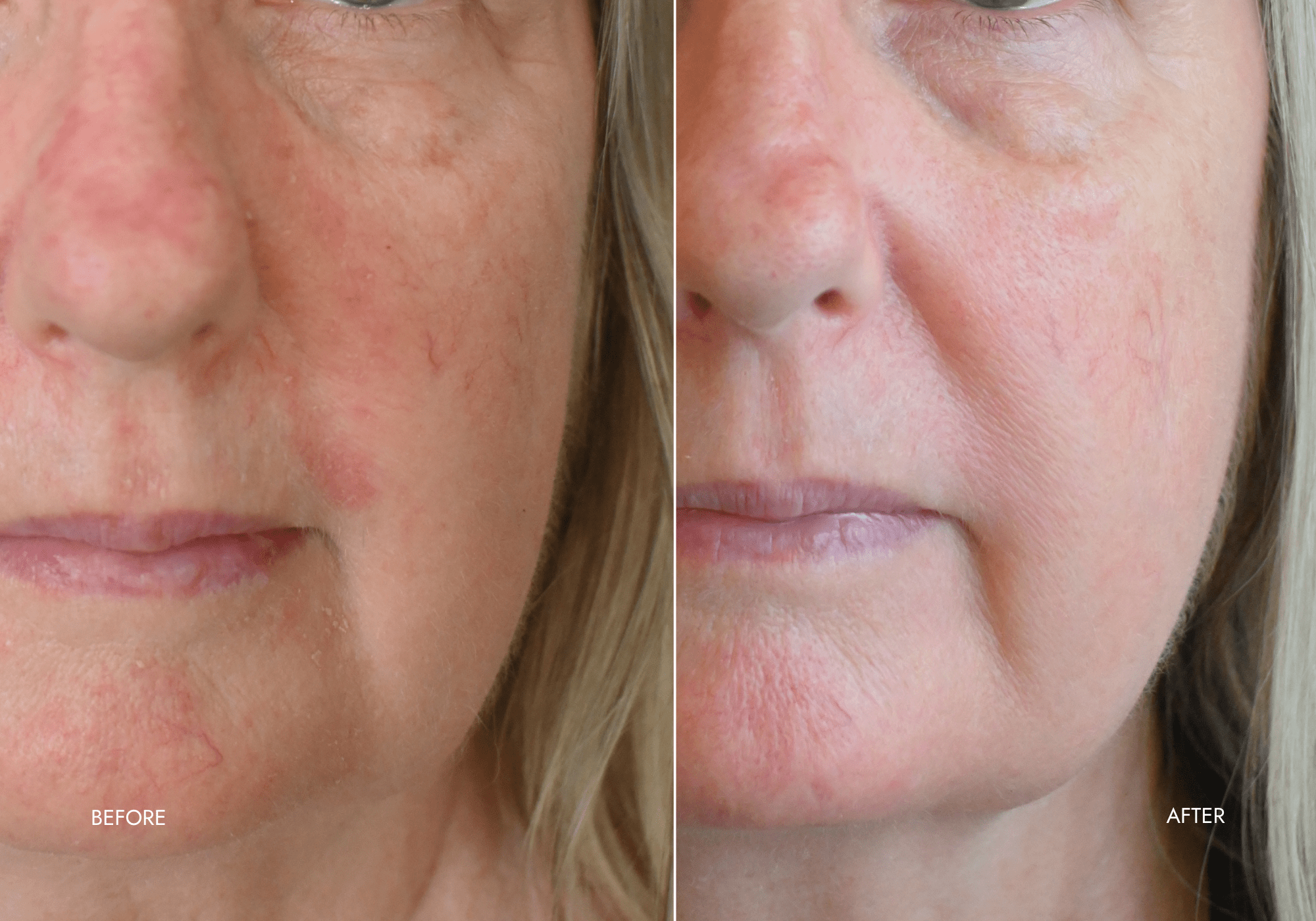 red light therapy before and after