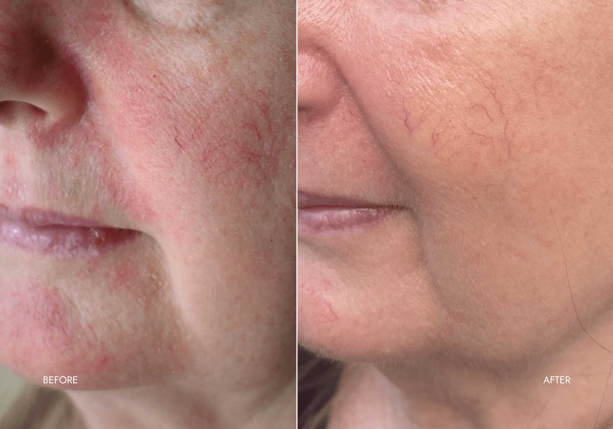 red light therapy before and after