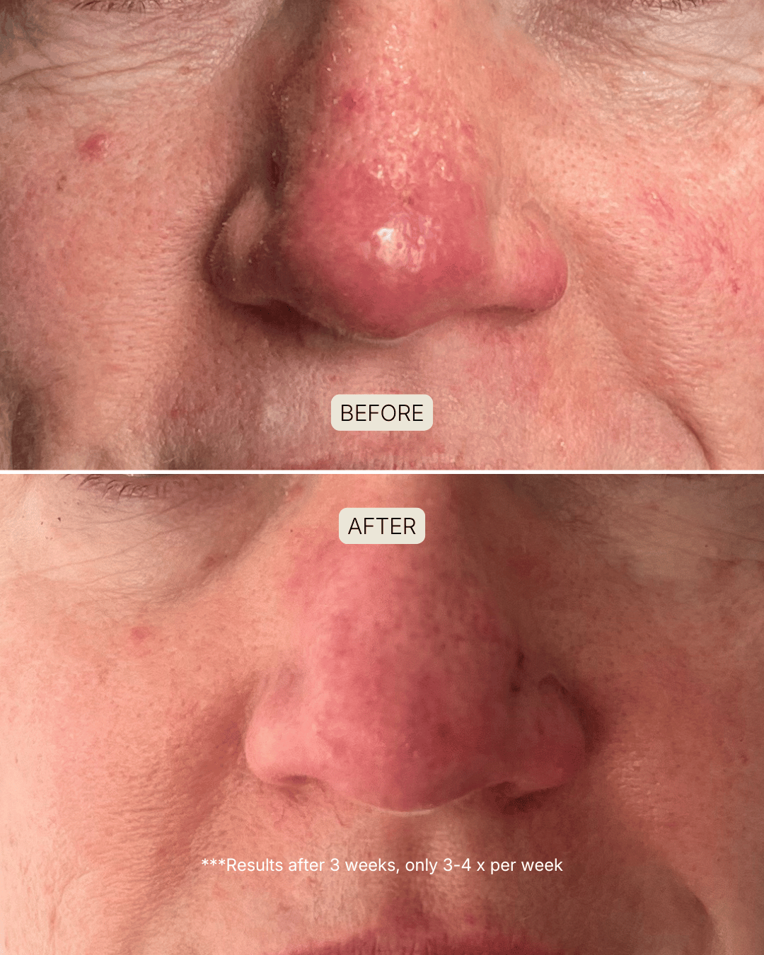 before and after photo after using souleir skin restore led red light therapy mask to treat symptoms of rosacea