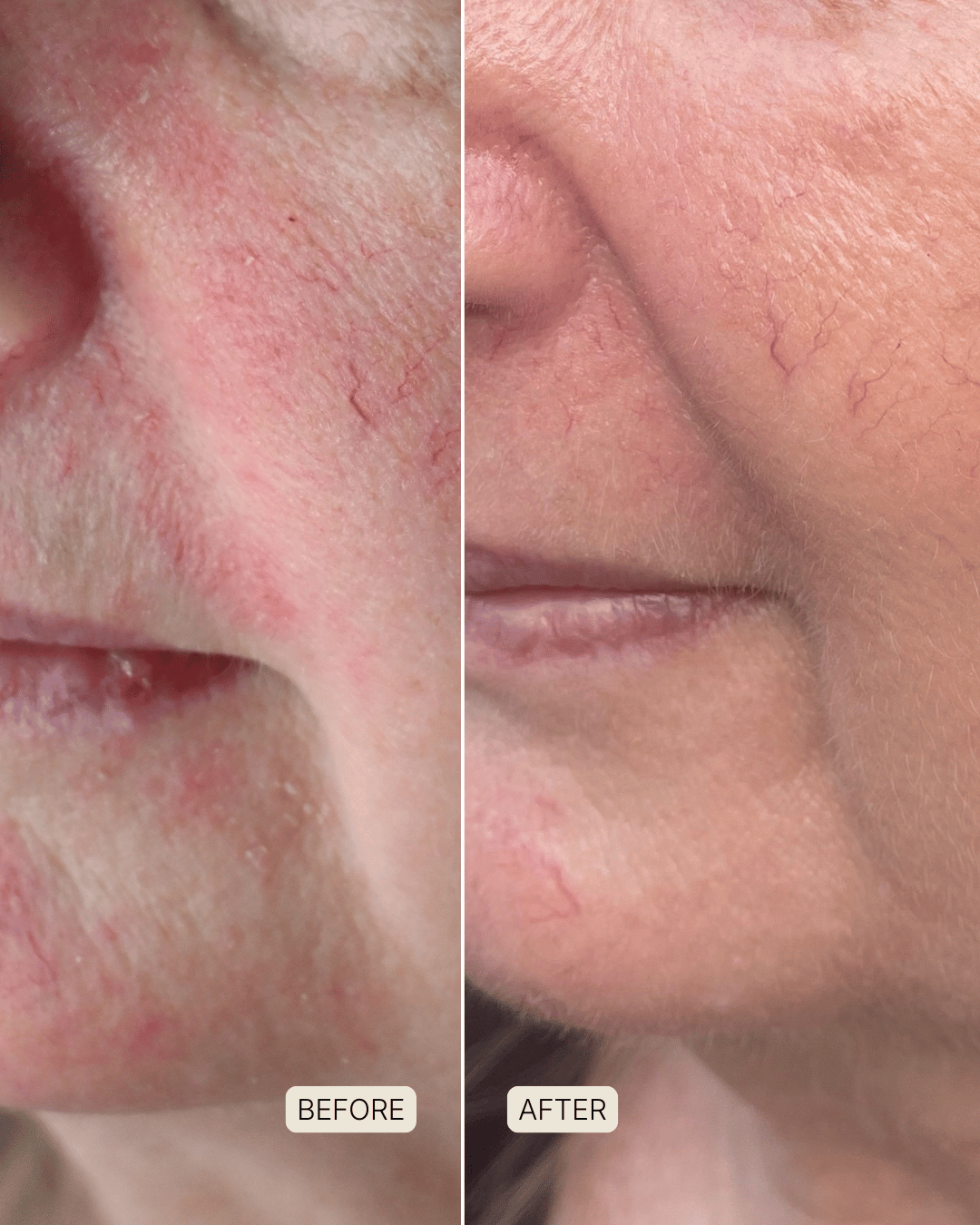 before and after photo after using souleir skin restore led red light therapy mask