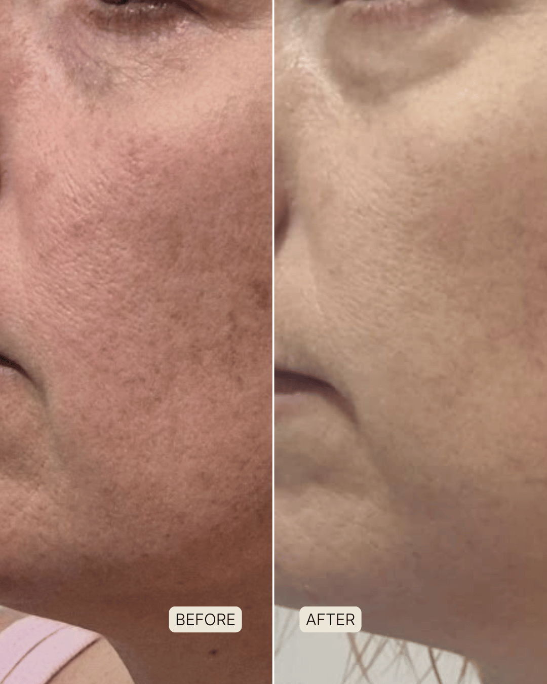 before and after photo after using souleir skin restore led red light therapy mask to lighten signs of pigmentation and minimise enlarged pores