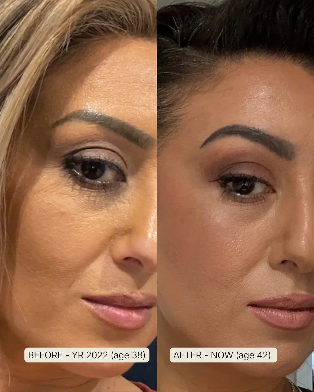 before and after souleir led therapy