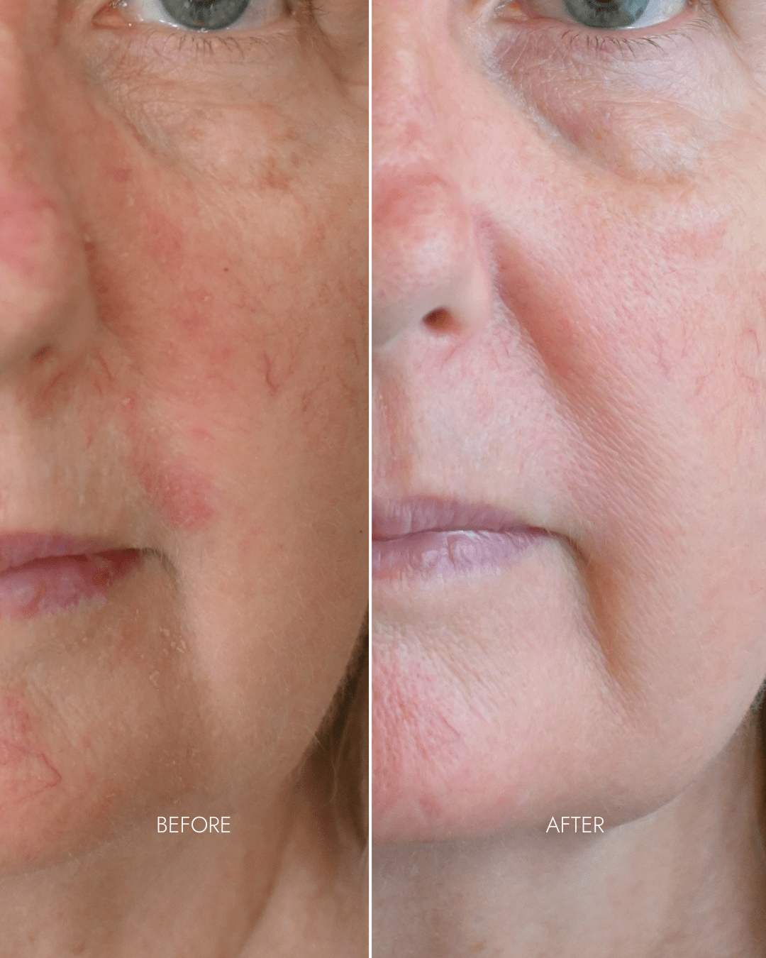 Youth Restore LED Therapy Mask