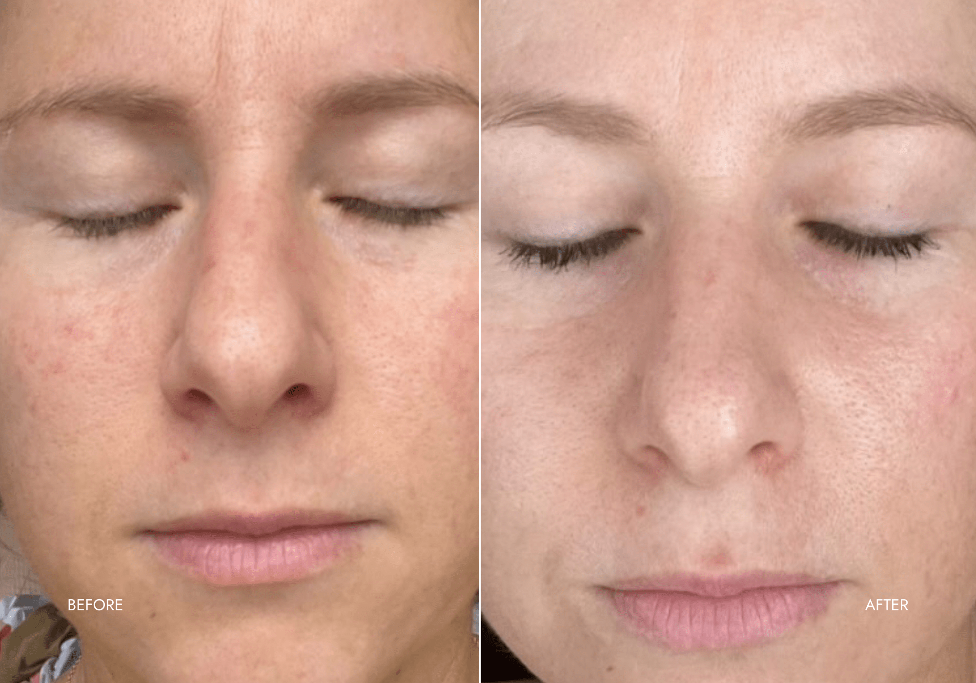 red light therapy before and after