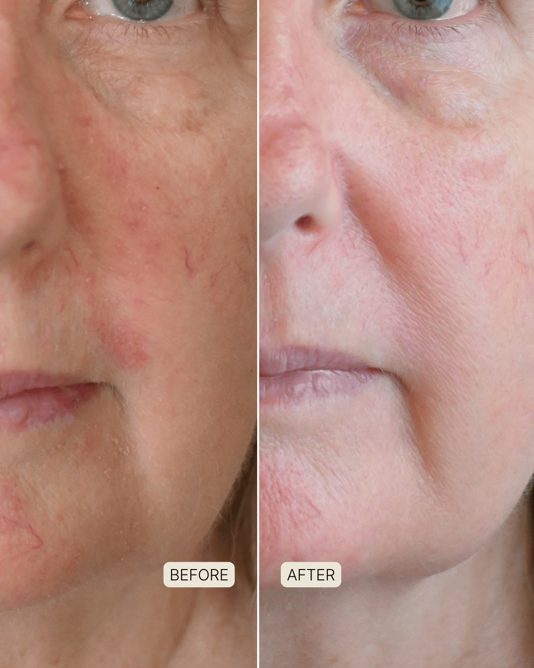 before and after photo after souleir skin restore led red light therapy mask treatment