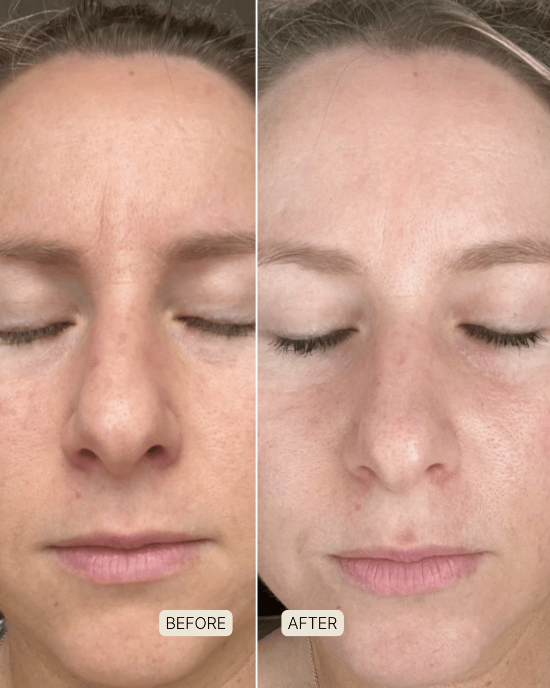 LED Skin Restore - Complete System