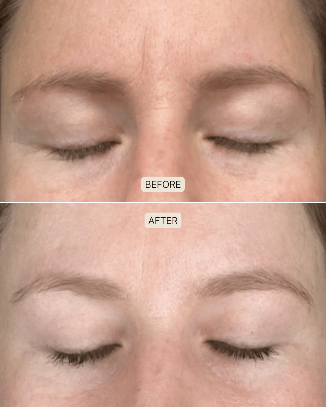 before and after photo after using souleir skin restore led red light therapy mask to treat wrinkle in the brow area