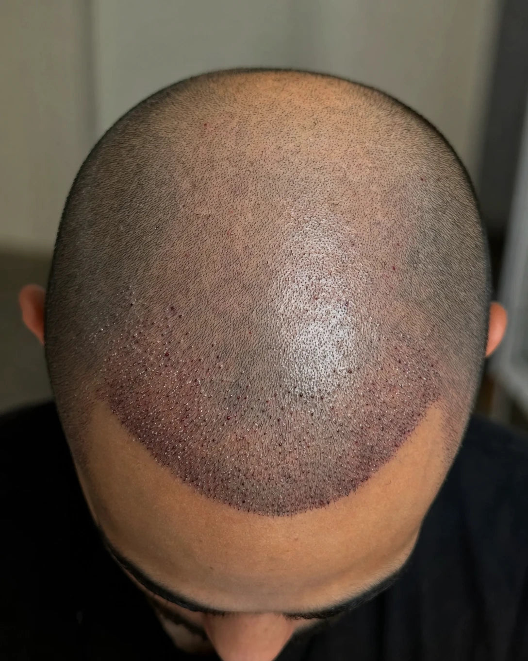 Close-up of FUE hair transplant graft sites on scalp - post hair transplant care recovery Australia